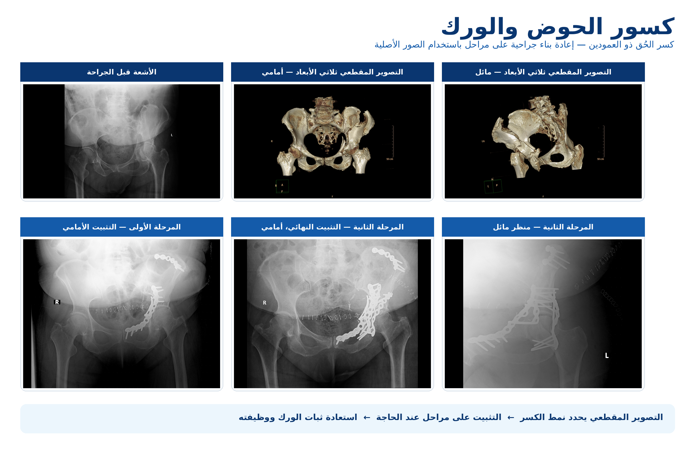 مثال سريري عربي مركب يوضح كسر الحُق ذي العمودين في الأشعة والتصوير المقطعي ثلاثي الأبعاد قبل الجراحة، ثم التثبيت الأمامي والتثبيت النهائي على مراحل.