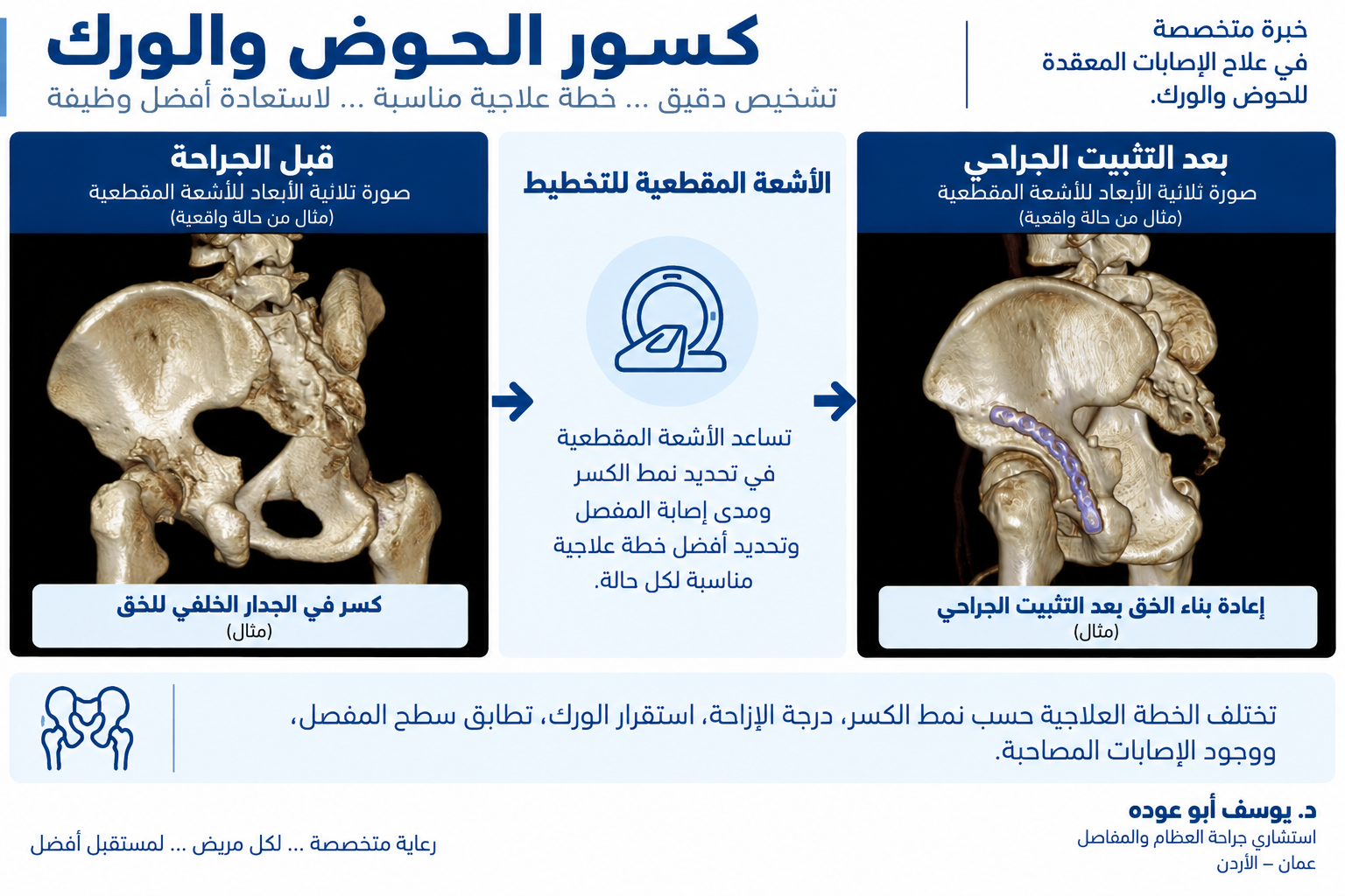 مثال سريري عربي يوضح صوراً ثلاثية الأبعاد بالتصوير المقطعي لكسر الجدار الخلفي للحُق قبل الجراحة وبعد التثبيت.