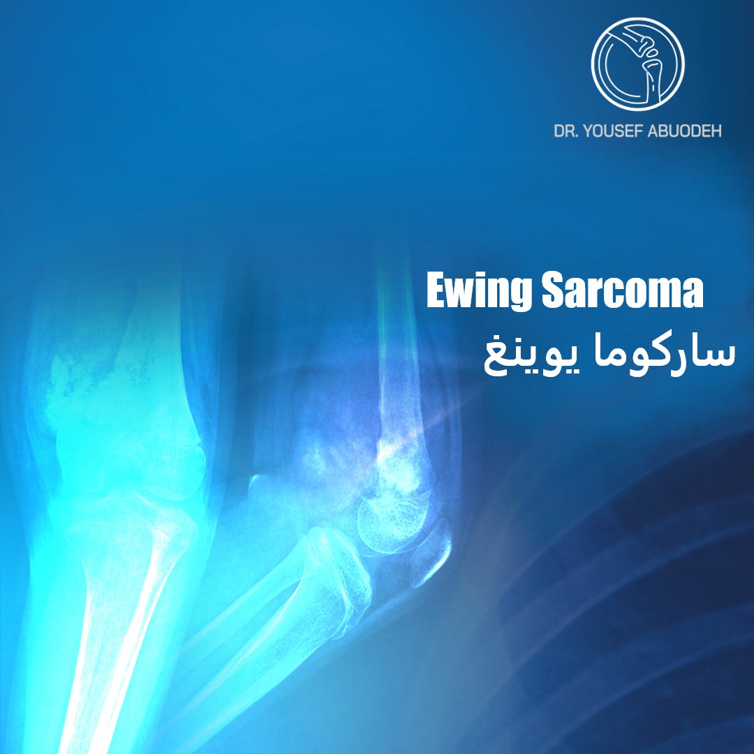 ساركوما يوينغ  Ewing Sarcoma